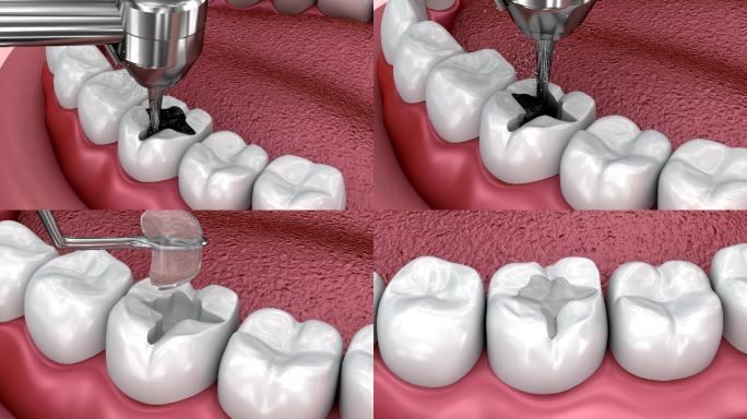 龋齿去除3D插图三维动画口腔植牙破损
