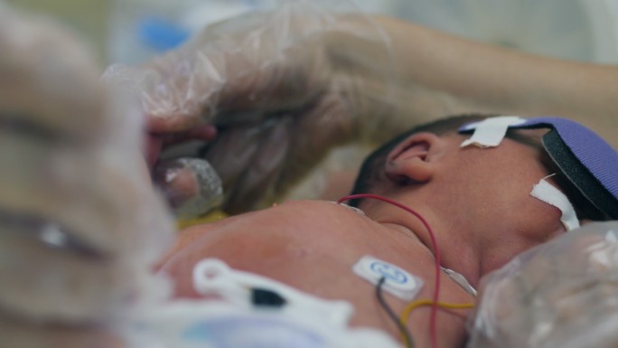 婴儿刚出生的婴儿检查护理
