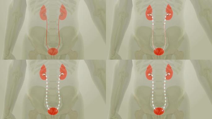 3D动画演示了在肾脏中植入输尿管支架