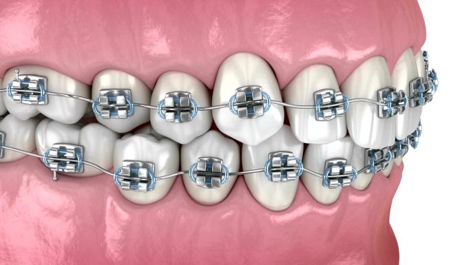 异常牙齿位置和用金属支架矫正。