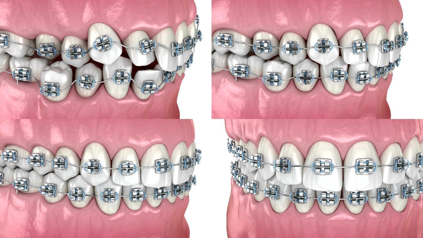 异常牙齿位置和用金属支架矫正。