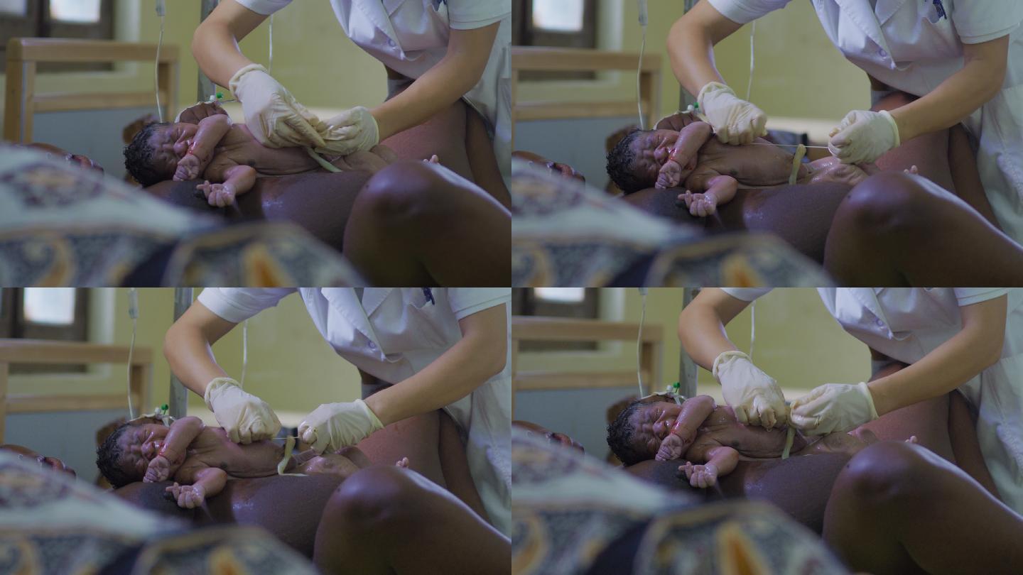 非洲医院里医生给婴儿剪断脐带