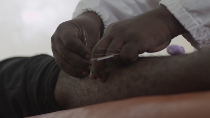 非洲医生在非洲医院给病人做针灸治疗