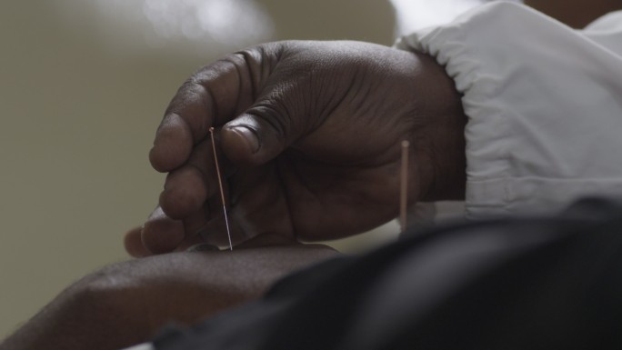 非洲医生在非洲医院给病人做针灸治疗