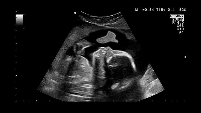 医学检查显示，怀孕期间超声波检查