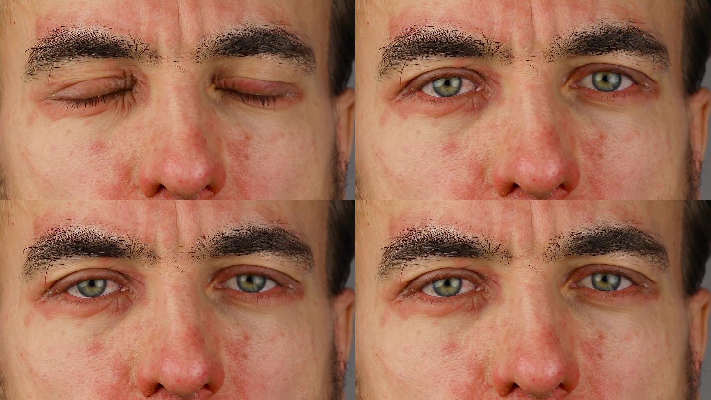 男人眨着两只眼睛出现红色过敏反应
