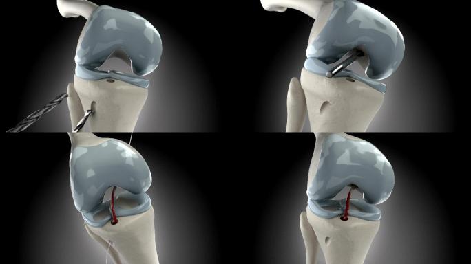 三维视野下膝关节镜下交叉韧带置换术