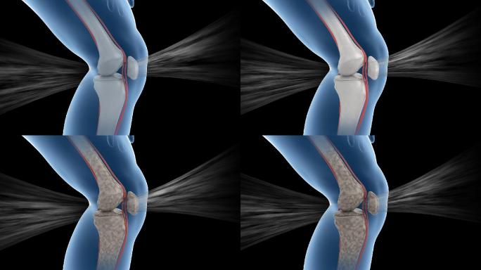 人体机理动画 ——膝盖疼 带透明通道