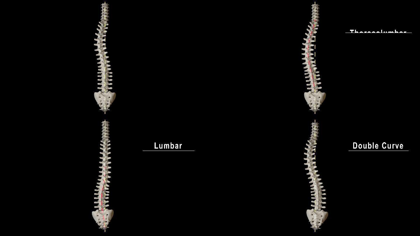 脊柱侧凸曲线类型
