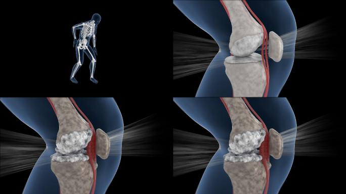 人体机理动画 ——膝盖疼 带透明通道