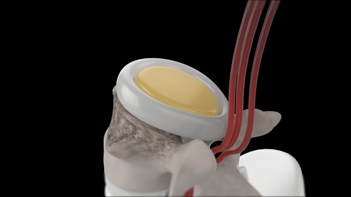 人体机理动画 — 腰间盘修复 带透明通道
