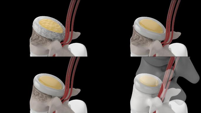 人体机理动画 — 腰间盘修复 带透明通道