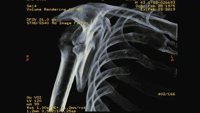 右肩CT显示肩胛骨骨折三维重建图像