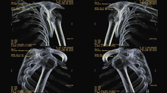 右肩CT显示肩胛骨骨折三维重建图像