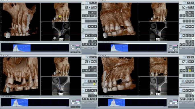 医生正在检查3D牙齿扫描