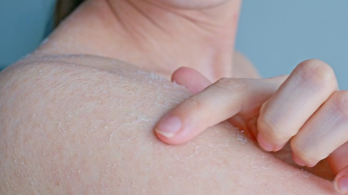 身体上的皮肤因晒伤而起水泡。