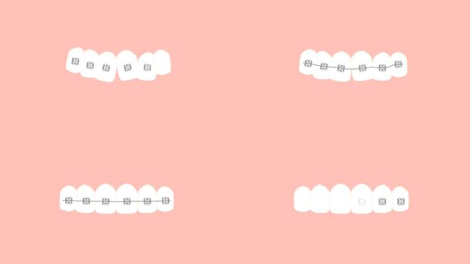 牙套矫正牙齿的视频动画
