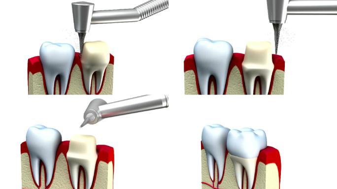 牙冠安装工艺安装假牙齿三维动画特效口腔医
