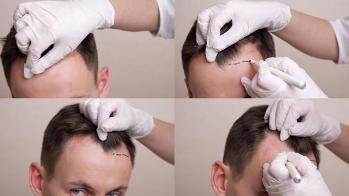 医务人员在男子头上画了虚线准备植发