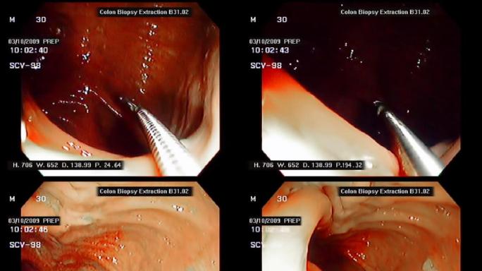 结肠活检工具消化道体检溃疡肠道疾病医院