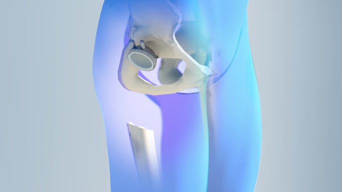 髋关节置换术植入骨盆骨内。