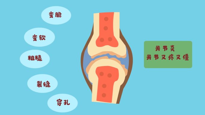 mg关节炎医疗动画