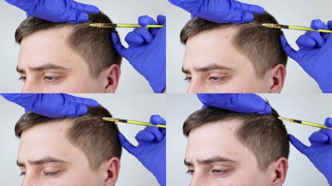 美容师医生在男子头部注射促进头发生长