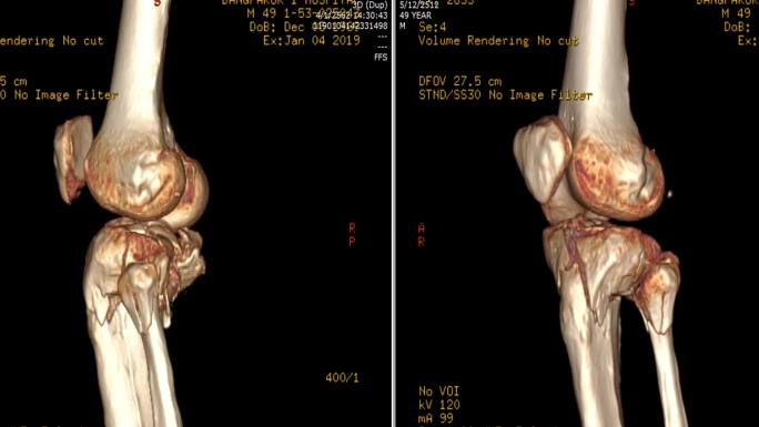 左膝的CT扫描图像