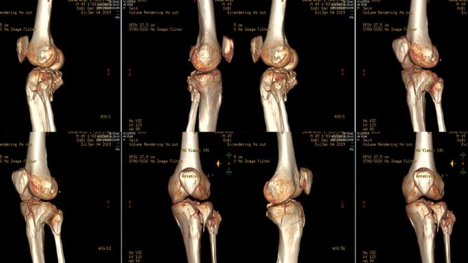 左膝的CT扫描图像