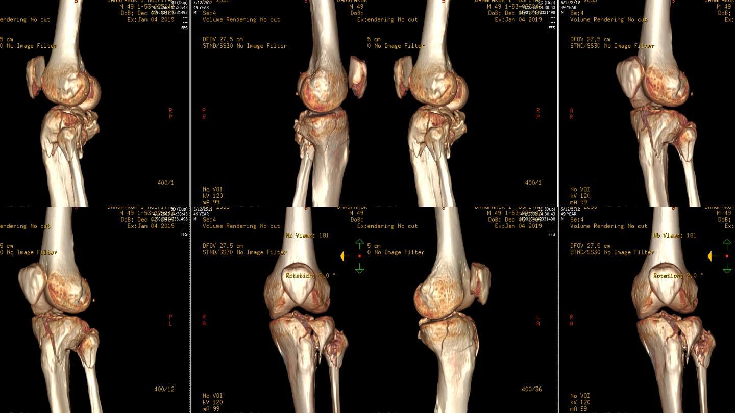左膝的CT扫描图像
