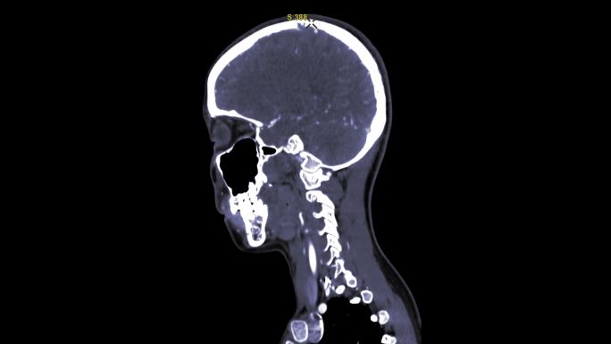 CT脑矢状视图医生医学设备ct检查护士医