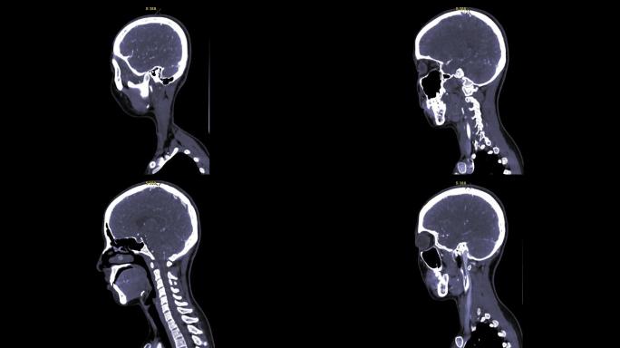 CT脑矢状视图医生医学设备ct检查护士医
