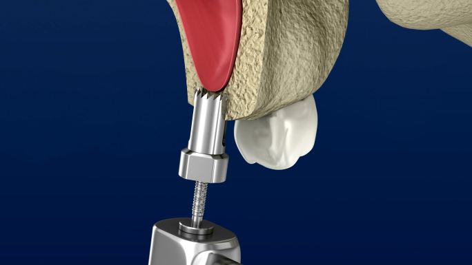 植牙3D动画。特效合成元素医疗牙科