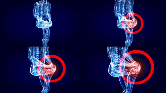 膝盖扭伤或疼痛三维医学器官3D人体