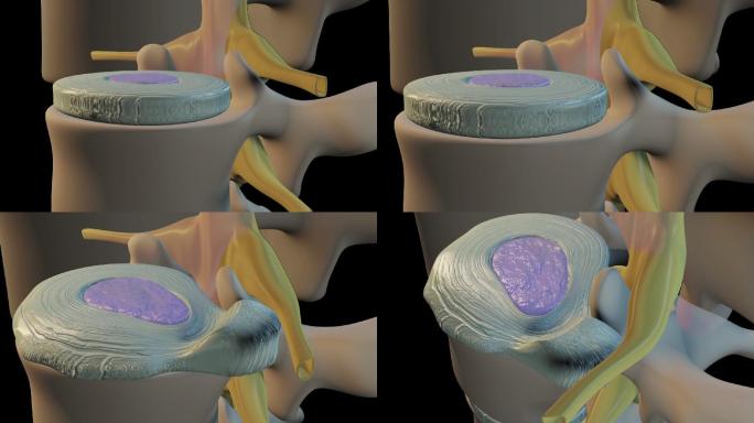 脊椎疾病后期动画机理动画疗效效果药效功效