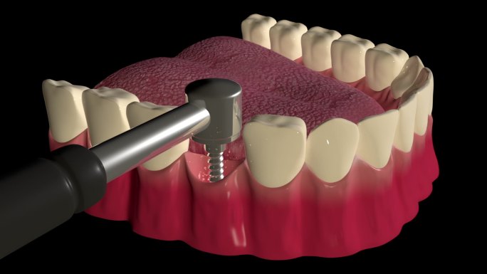 牙种植程序口腔健康补牙齿动画模拟种牙