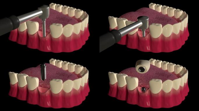 牙种植程序口腔健康补牙齿动画模拟种牙