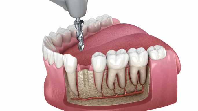 种植修复缺失牙补牙修牙种牙拔牙牙医专家