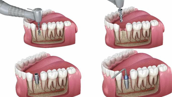 种植修复缺失牙补牙修牙种牙拔牙牙医专家
