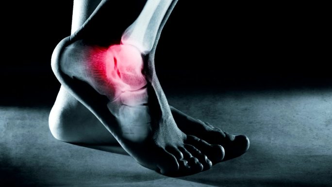 x射线中的人脚踝人体组织器官疾病骨骼