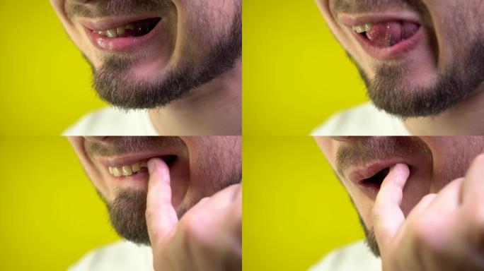一名男子正试图用手指将卡住的食物从牙齿间拔出