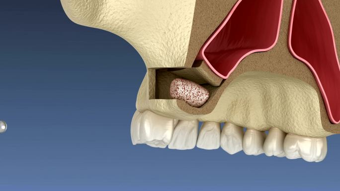 侧入路鼻窦提升术。牙科手术的3D动画