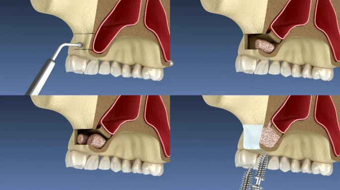 侧入路鼻窦提升术。牙科手术的3D动画