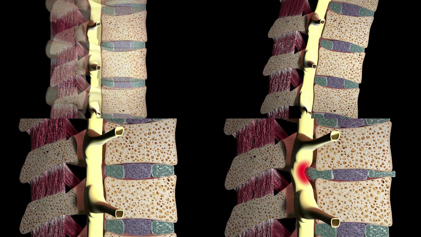突出椎间盘切面图模拟人拉伸修护椎骨问题劳