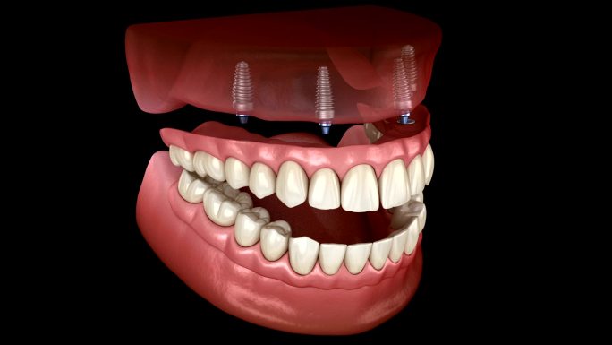 人体牙齿和假牙概念的医学精确3D动画