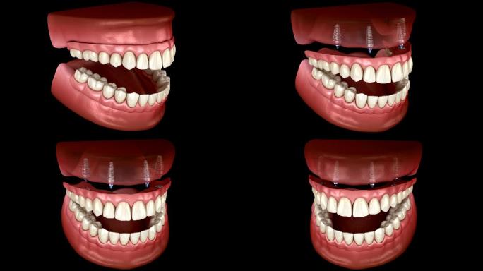 人体牙齿和假牙概念的医学精确3D动画