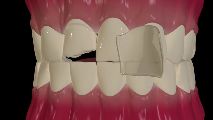牙冠复盖体