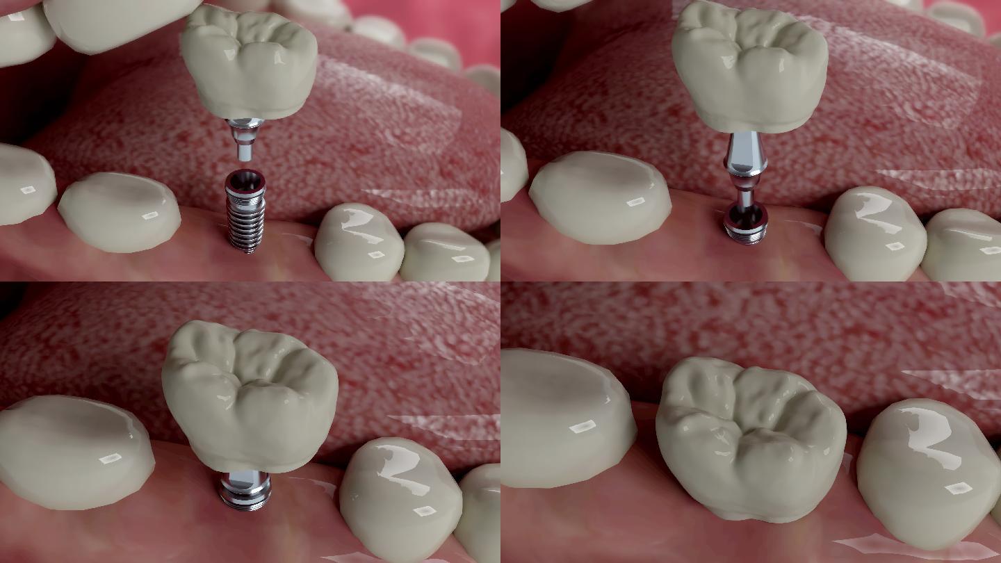牙齿植入物安装动画3d口腔牙龈