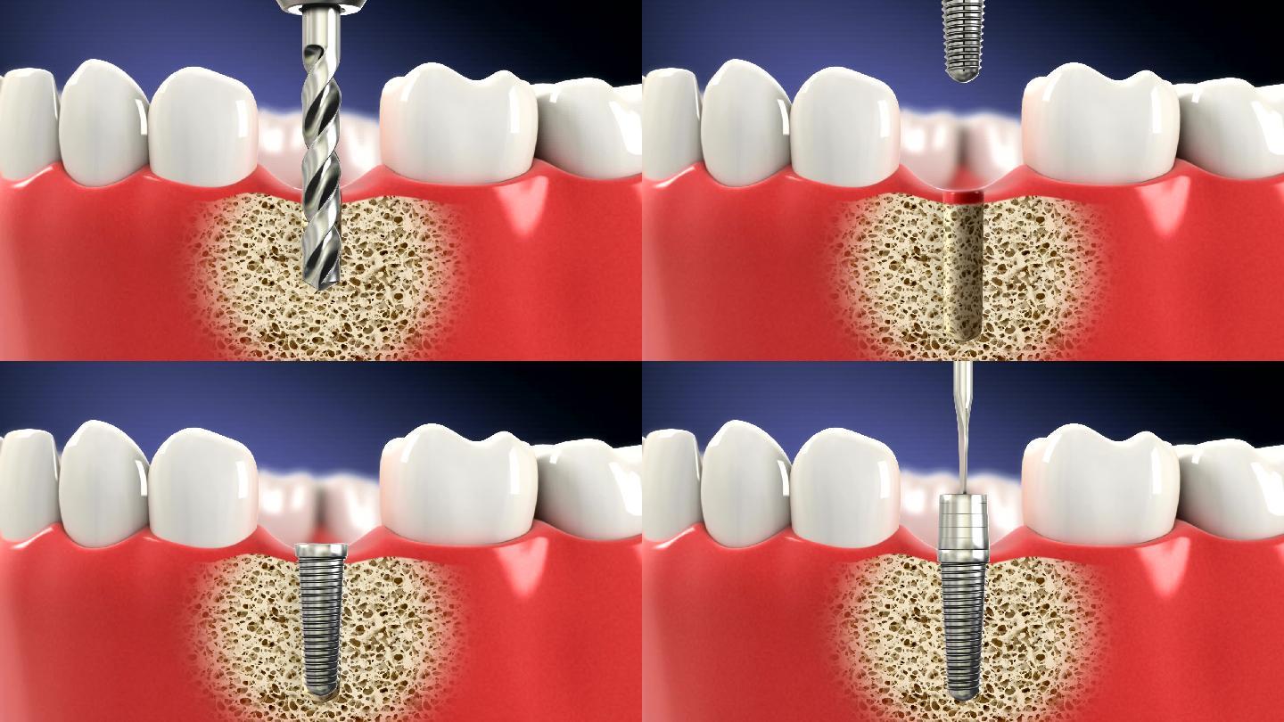 假牙的安装过程3D动画