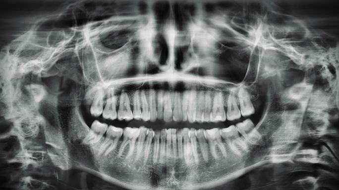 会说话的下巴x光片。